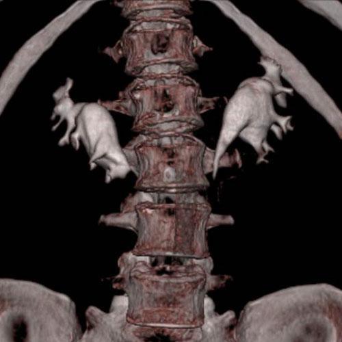 Riñón en herradura 2