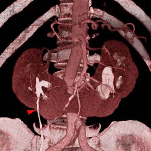 Riñón en herradura 2