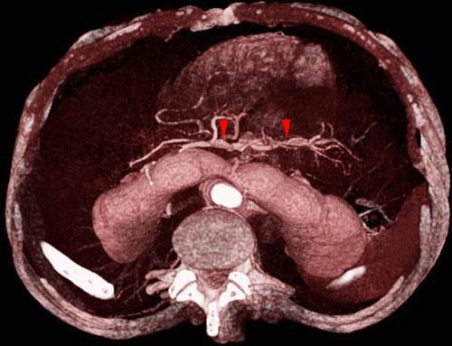 Riñón en herradura 2