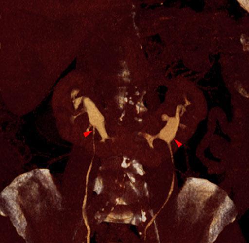 Riñón en herradura 1