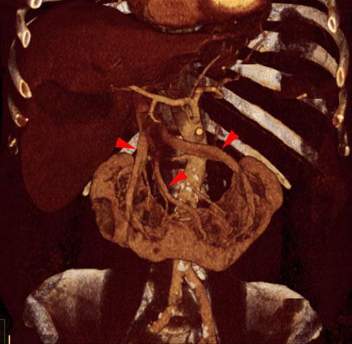 Riñón en herradura 1