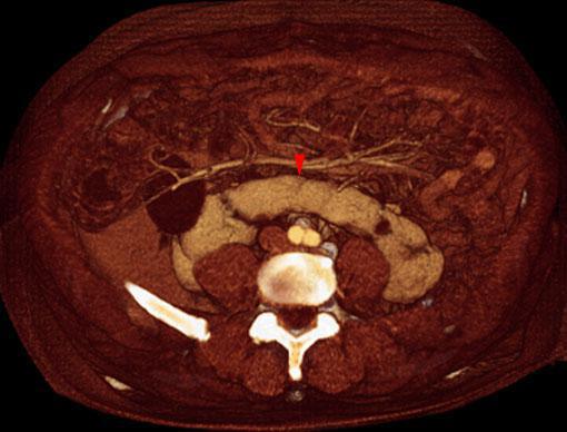 Riñón en herradura 1