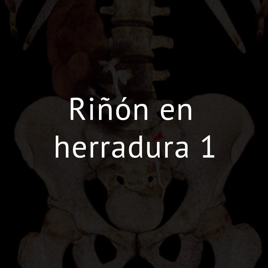 Riñón en herradura 1