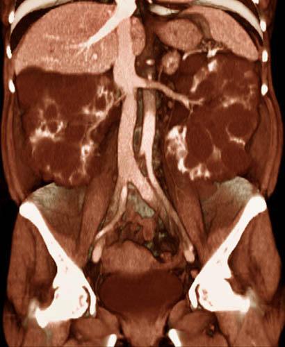 Poliquistosis renal