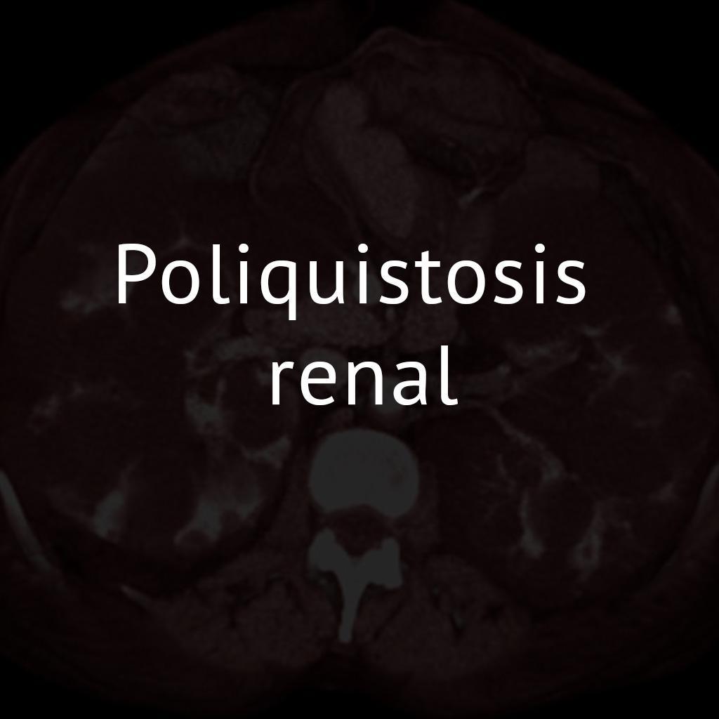Poliquistosis renal