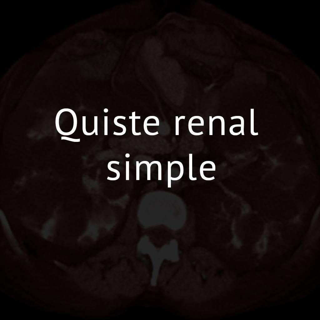 Quiste renal simple