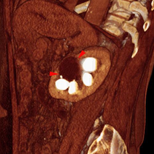 Quiste renal pielosinusal
