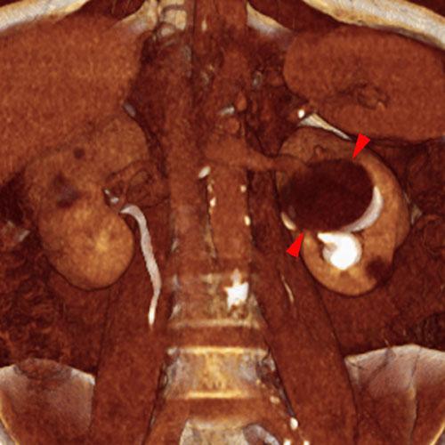 Quiste renal pielosinusal