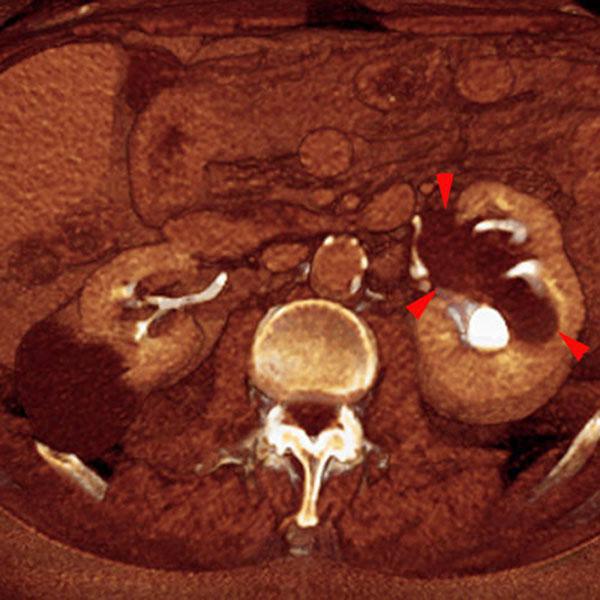 Quiste renal pielosinusal