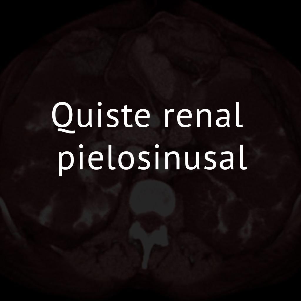 Quiste renal pielosinusal