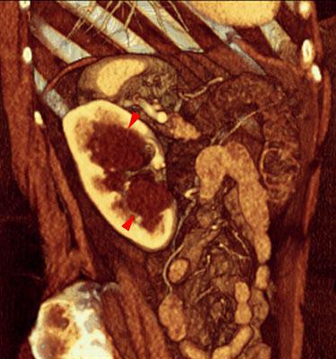 Quistes renales pielosinusales