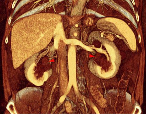 Quistes renales pielosinusales 