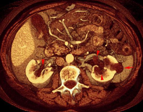 Quistes renales pielosinusales 