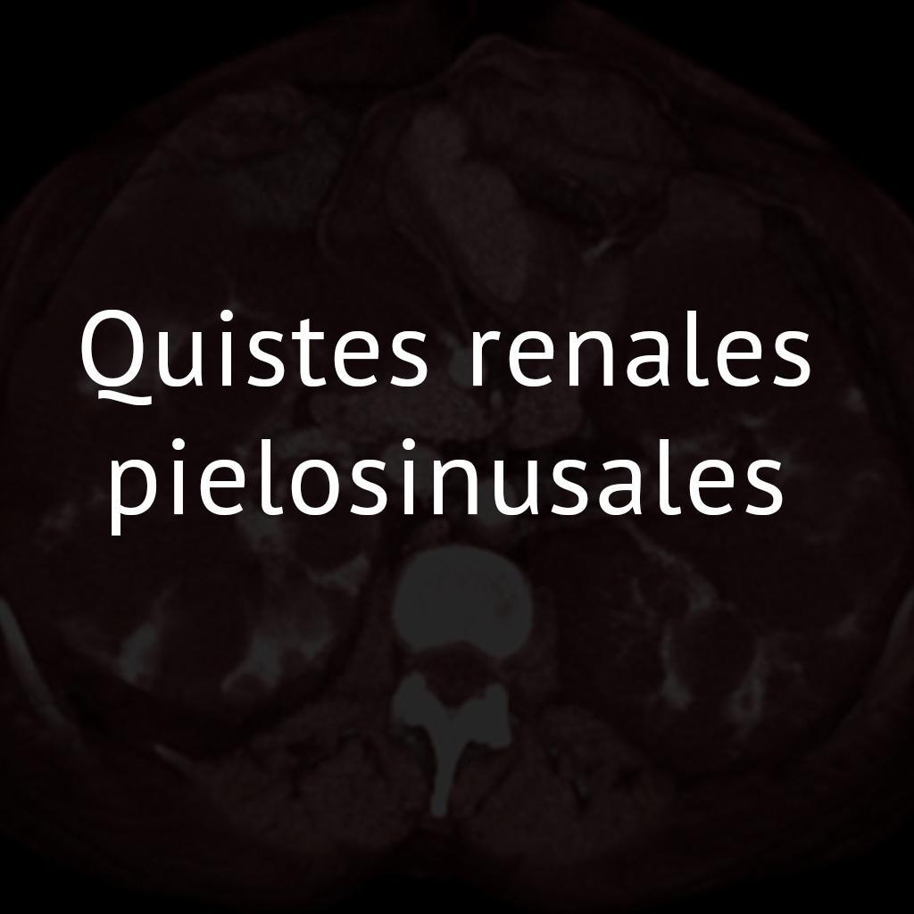 Quistes renales pielosinusales 