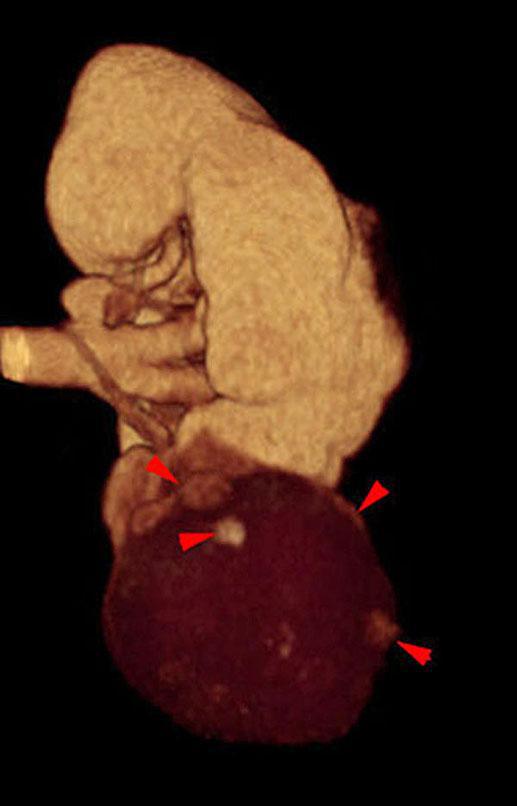 Quiste renal complejo sugestivo de neoplasia