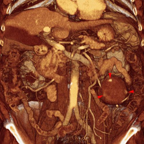Quiste renal complejo sugestivo de neoplasia