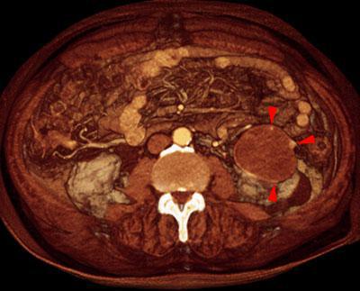 Quiste renal complejo sugestivo de neoplasia