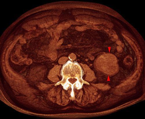 Quiste renal complejo sugestivo de neoplasia