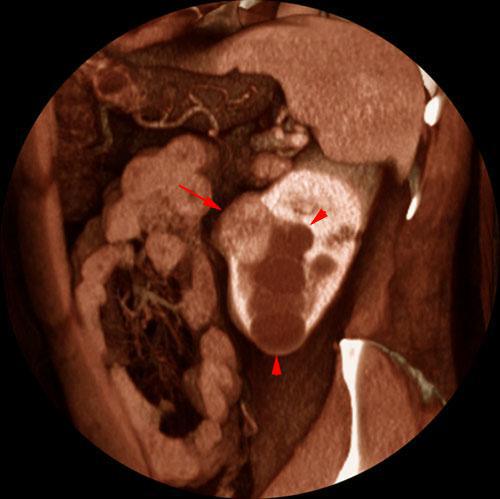 Quiste renal multitabicado e hipernefroma