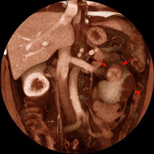Quiste renal multitabicado e hipernefroma