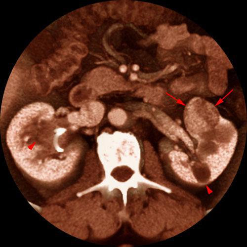 Quiste renal multitabicado e hipernefroma