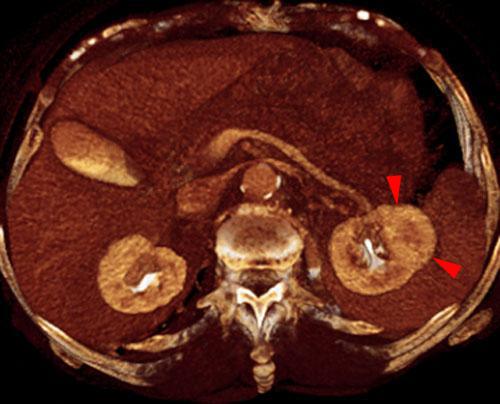 Quiste renal hemorrágico