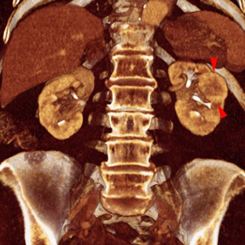 Quiste renal hemorrágico