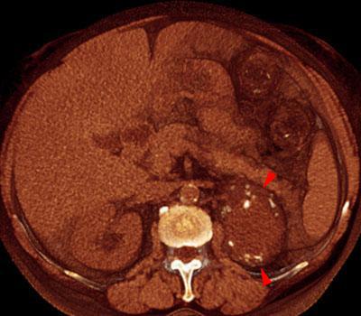 Quiste renal calcificado