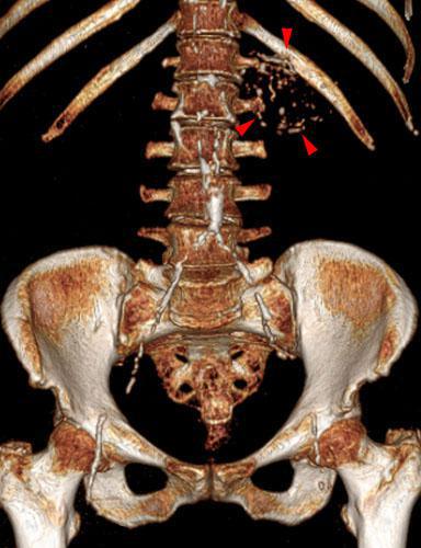 Quiste renal calcificado