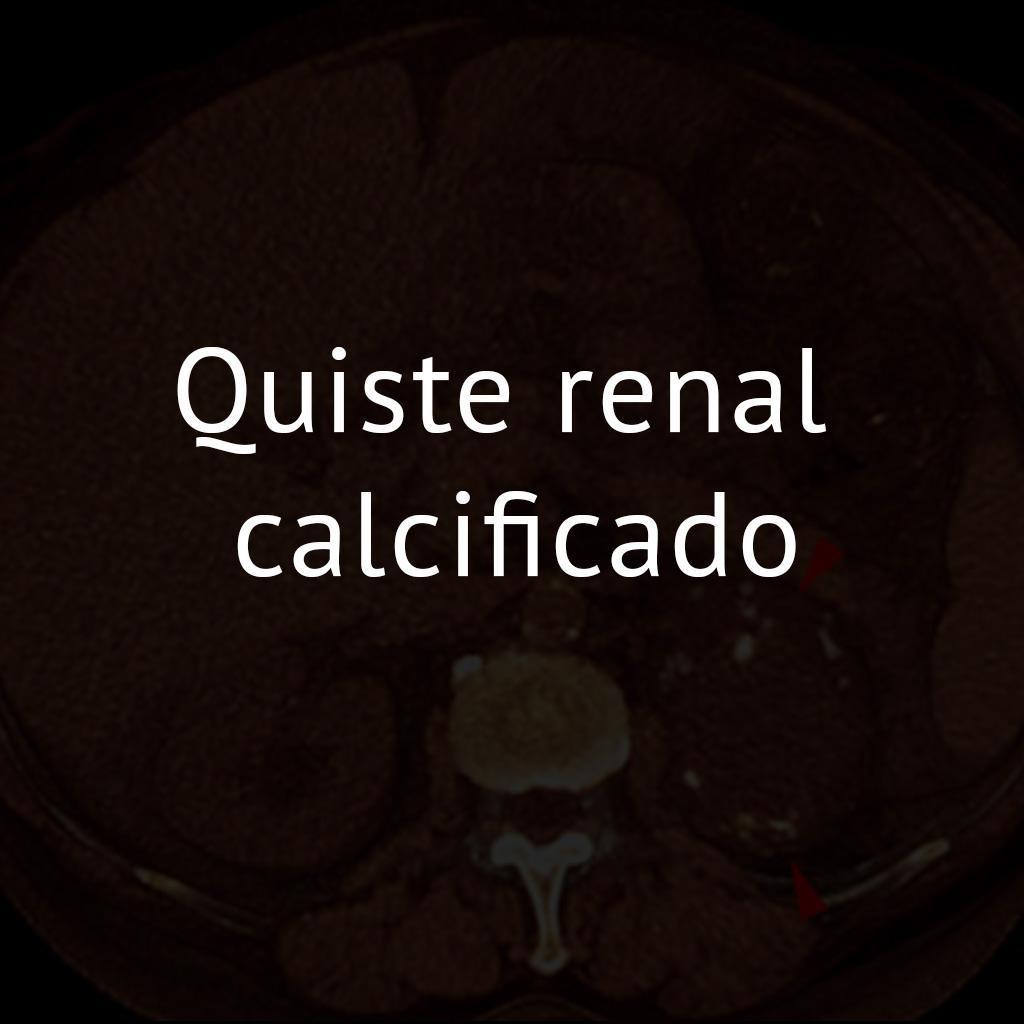 Quiste renal calcificado