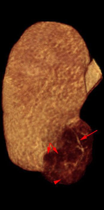 Angiomiolipoma renal 2