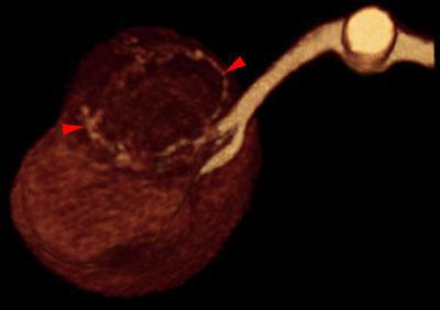 Angiomiolipoma renal 2