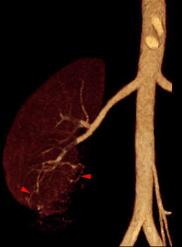 Angiomiolipoma renal 2