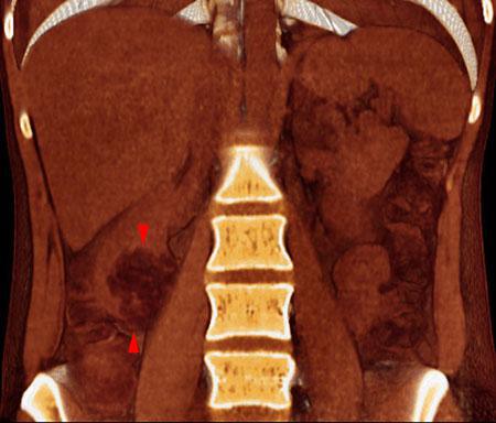 Angiomiolipoma renal 2