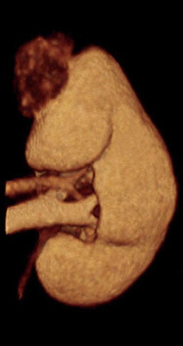 Angiomiolipoma renal 1