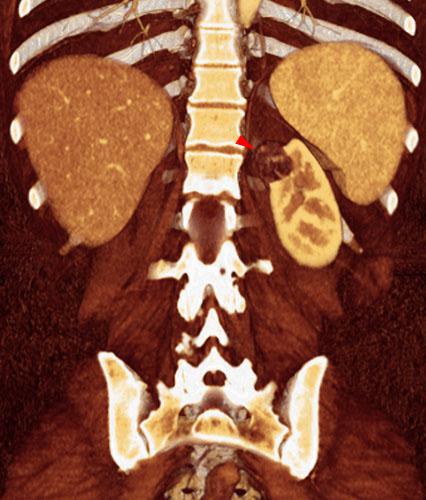 Angiomiolipoma renal 1