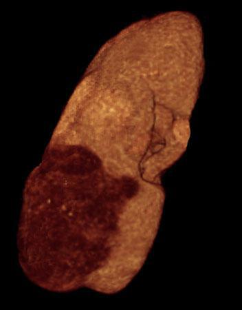 Nefroma quístico multiocular