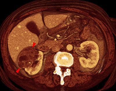Nefroma quístico multilocular
