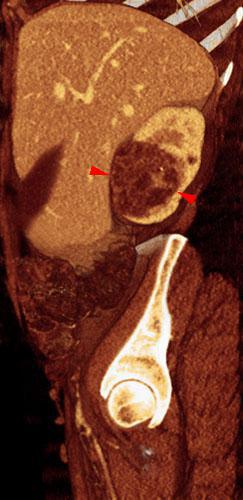 Nefroma quístico multilocular