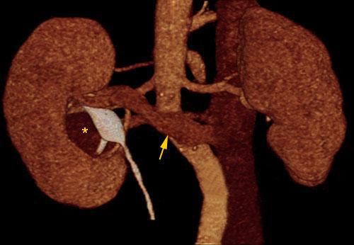 Tumor del seno renal