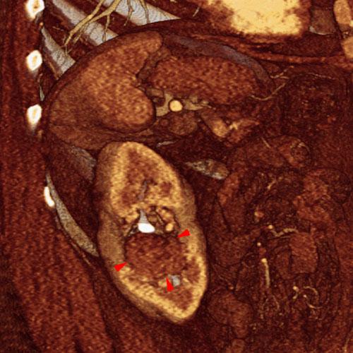 Tumor del seno renal