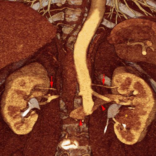 Tumor del seno renal