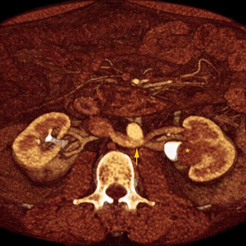 Tumor del seno renal