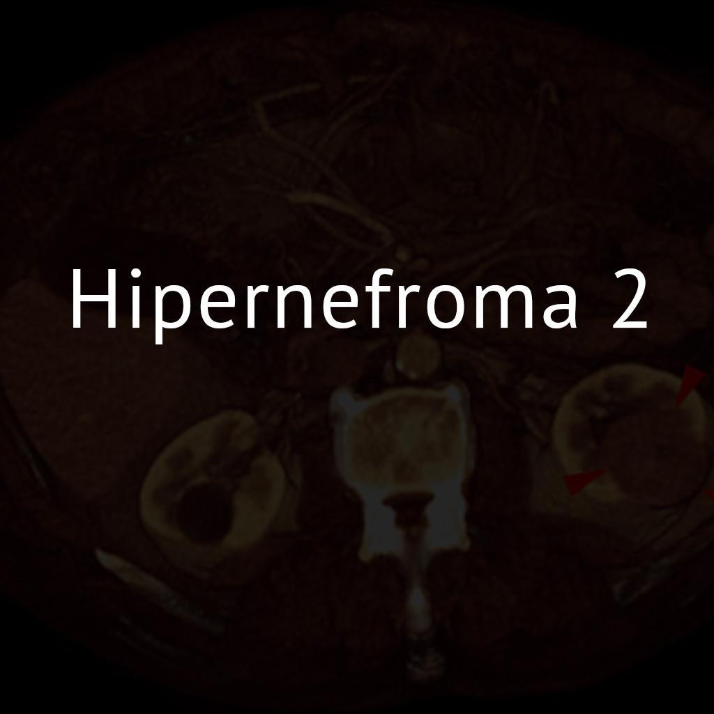 Hipernefroma 2
