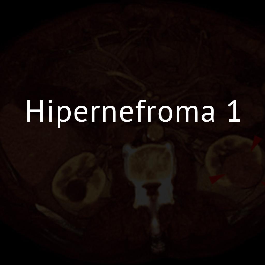 Hipernefroma 1