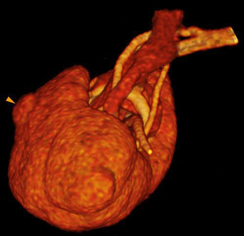 Pequeño hipernefroma