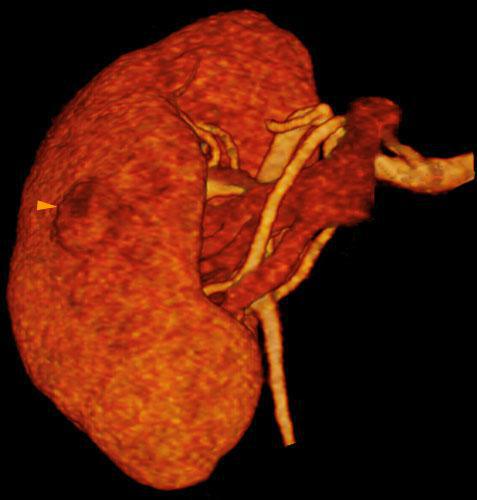 Pequeño hipernefroma