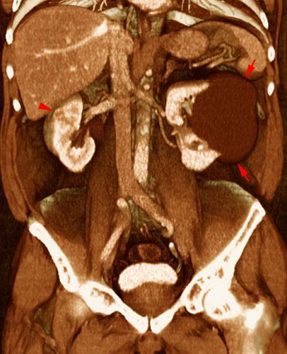 Pequeño hipernefroma