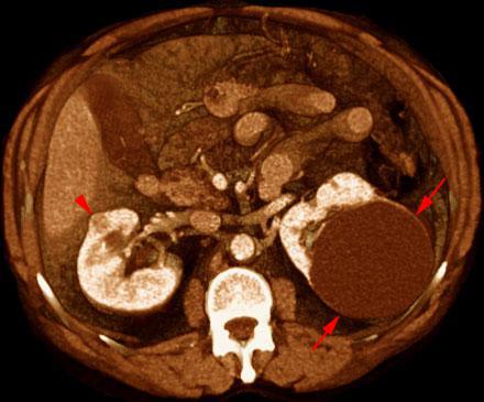 Pequeño hipernefroma