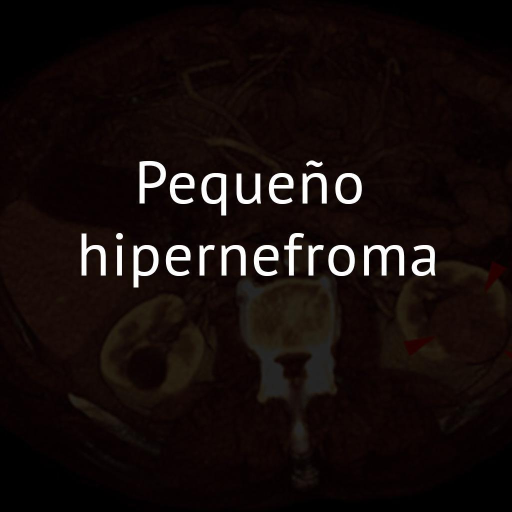 Pequeño hipernefroma